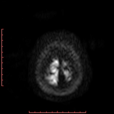 Astroblastoma (Radiopaedia 74287-85162 Axial DWI 108).jpg