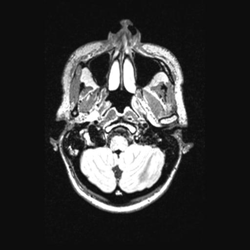 Atretic encephalocoele with inferior vermis hypoplasia (Radiopaedia 30443-31108 Axial 30).jpg