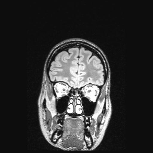 Atretic encephalocoele with inferior vermis hypoplasia (Radiopaedia 30443-31108 Coronal FLAIR 146).jpg