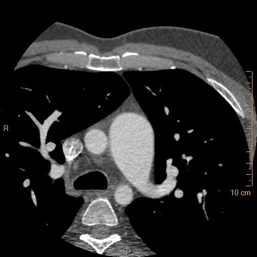 Atrial septal defect (upper sinus venosus type) with partial anomalous pulmonary venous return into superior vena cava (Radiopaedia 73228-83961 A 30).jpg