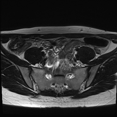 File:Atypical deep infiltrating endometriosis (Radiopaedia 44470-48125 Axial T2 3).jpg