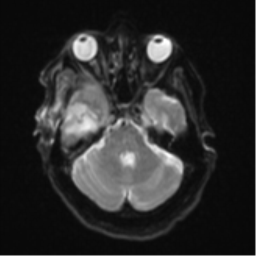 Atypical meningioma (WHO Grade II) (Radiopaedia 54742-60981 Axial DWI 8).png