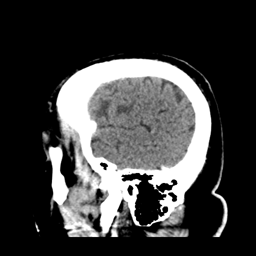 Atypical meningioma (WHO grade II) with brain invasion (Radiopaedia 57767-64728 Sagittal C+ 7).png