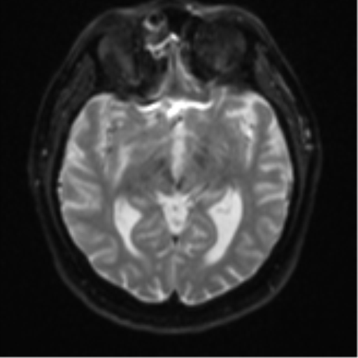 Atypical meningioma (WHO grade II) with brain invasion (Radiopaedia 57767-64729 Axial DWI 13).png