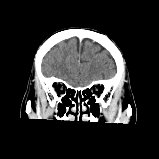Atypical meningioma (WHO grade II) with osseous invasion (Radiopaedia 53654-59715 Coronal C+ delayed 16).png