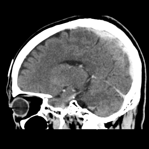Atypical meningioma (WHO grade II) with osseous invasion (Radiopaedia 53654-59715 G 33).png