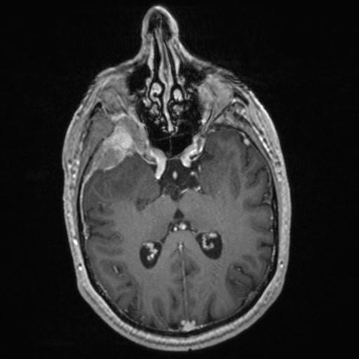 Atypical meningioma (grade II) - en plaque (Radiopaedia 29633-30147 Axial T1 C+ 88).jpg