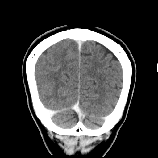Atypical meningioma with skull invasion (Radiopaedia 34357-35649 Coronal C+ delayed 50).png