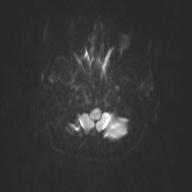 Autoimmune limbic encephalitis (Radiopaedia 30363-31005 Axial B0 and DWI 37).jpg