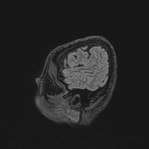 File:Autoimmune limbic encephalitis (Radiopaedia 30363-31005 Sagittal FLAIR 135).jpg