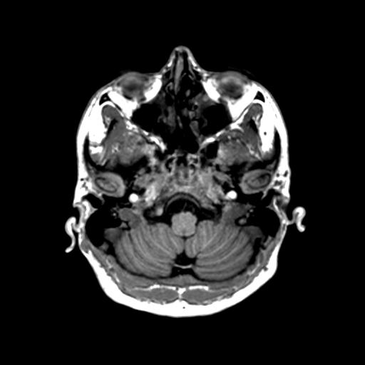 Autoimmune limbic encephalitis (Radiopaedia 30363-31005 T1 Axial 1mm 30).jpg