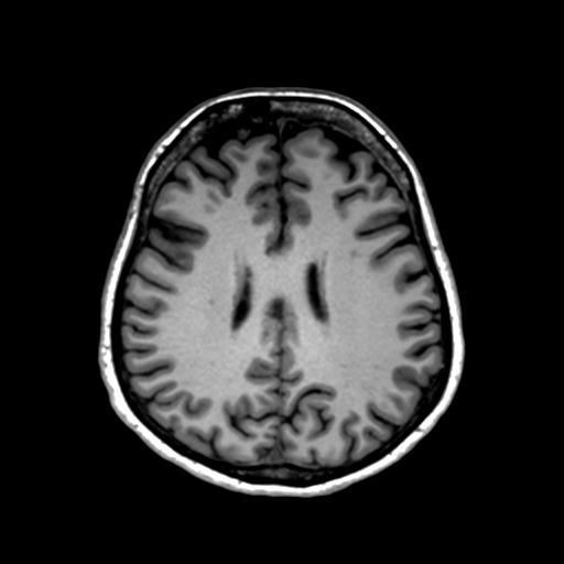 File:Autoimmune limbic encephalitis (Radiopaedia 30363-31005 T1 Axial 1mm 99).jpg