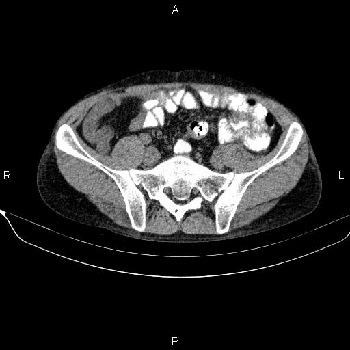 Autoimmune pancreatitis (Radiopaedia 84925-100431 Axial non-contrast 41).jpg