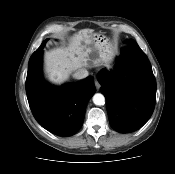 Autosomal dominant polycystic kidney disease (Radiopaedia 27851-28094 B 48).jpg