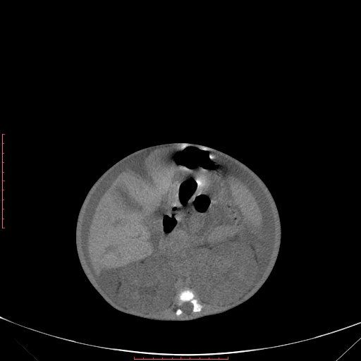 Autosomal recessive polycystic kidney disease associated with Caroli disease (Radiopaedia 61932-69984 Axial non-contrast 189).jpg
