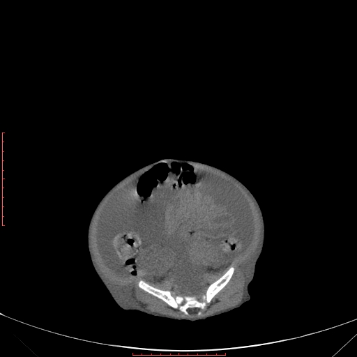 File:Autosomal recessive polycystic kidney disease associated with Caroli disease (Radiopaedia 61932-69984 B 294).jpg