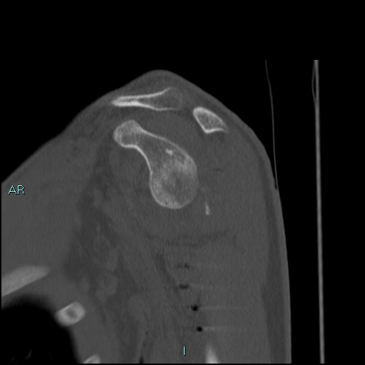 Avascular necrosis after fracture dislocations of the proximal humerus (Radiopaedia 88078-104653 Sagittal bone window 35).jpg