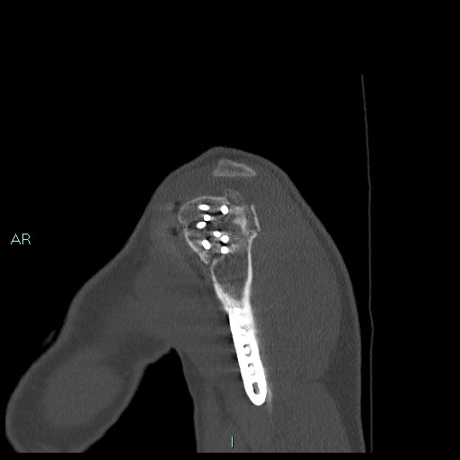 Avascular necrosis after fracture dislocations of the proximal humerus (Radiopaedia 88078-104655 Sagittal bone window 14).jpg