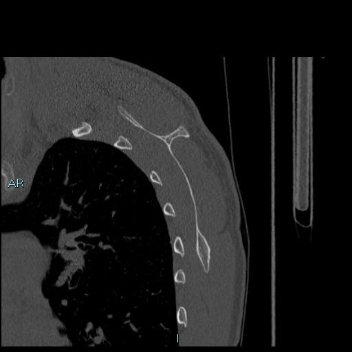 Avascular necrosis after fracture dislocations of the proximal humerus (Radiopaedia 88078-104655 Sagittal bone window 67).jpg