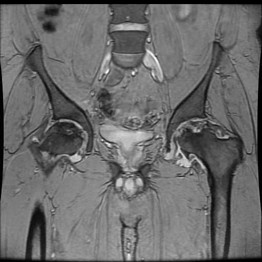 Avascular necrosis of the hip (Radiopaedia 61503-69465 F 41).jpg