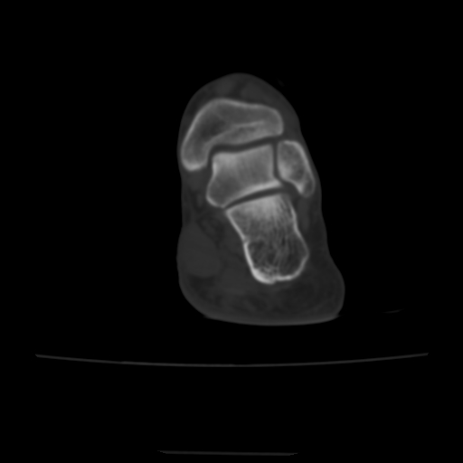 Avulsion fracture of the dorsal cuboid bone (Radiopaedia 51586-57377 Axial bone window 17).jpg