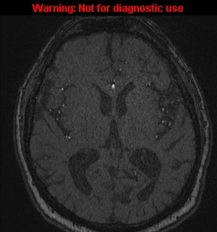 Azygos anterior cerebral artery (Radiopaedia 59325-66677 Axial MRA 92).jpg