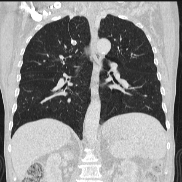 Azygos lobe (Radiopaedia 38259-40275 Coronal lung window 48).jpg