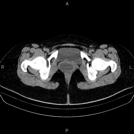 Bartholin gland cyst (Radiopaedia 62635-70930 Axial non-contrast 75).jpg