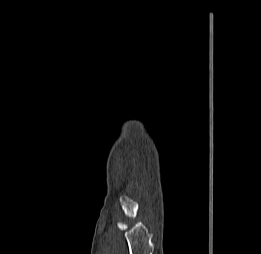 Base of 2nd metacarpal fracture (Radiopaedia 73741-84544 Sagittal bone window 27).jpg