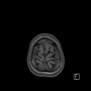 Base of skull rhabdomyosarcoma (Radiopaedia 32196-33142 Axial T1 50).jpg