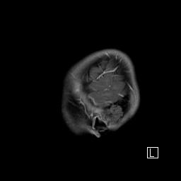 Base of skull rhabdomyosarcoma (Radiopaedia 32196-33142 J 8).jpg