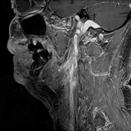 Base of tongue squamous cell carcinoma (Radiopaedia 31174-31884 F 125).jpg