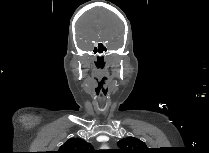 Basilar artery aneurysm (Radiopaedia 56261-62932 B 5).jpg