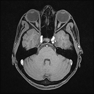 Basilar artery perforator aneurysm (Radiopaedia 82455-97733 Axial T1 fat sat 44).jpg