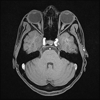 File:Basilar artery perforator aneurysm (Radiopaedia 82455-97733 Axial T1 fat sat 45).jpg