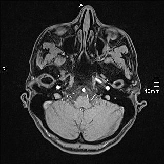 Basilar artery perforator aneurysm (Radiopaedia 82455-99523 F 17).jpg