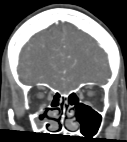 File:Basilar tip aneurysm with coiling (Radiopaedia 53912-60086 B 29).jpg