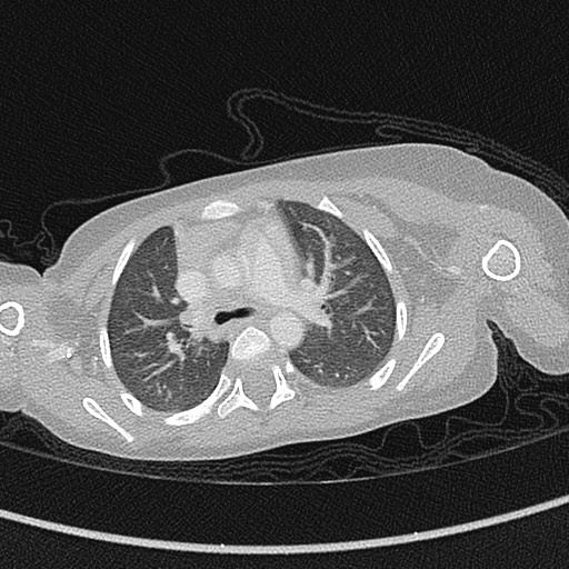 File:Beckwith-Wiedeman syndrome with bilateral Wilms tumors (Radiopaedia 60850-68629 Axial lung window 25).jpg