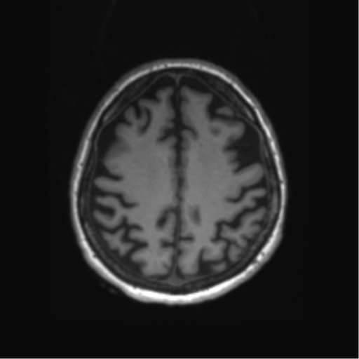 Behavioral variant frontotemporal dementia and late onset schizophrenia (Radiopaedia 52197-58083 Axial T1 21).png