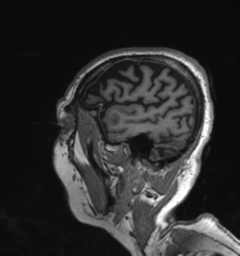 Behavioral variant frontotemporal dementia and late onset schizophrenia (Radiopaedia 52197-58083 Sagittal T1 3).png