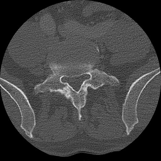 Benign post-traumatic pseudopneumoperitoneum (Radiopaedia 71199-81495 Axial bone window 271).jpg