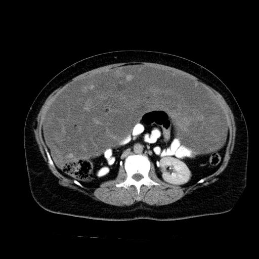 File:Benign spindle cell tumor - abdominopelvic (Radiopaedia 61300-69212 Axial C+ delayed 29).jpg