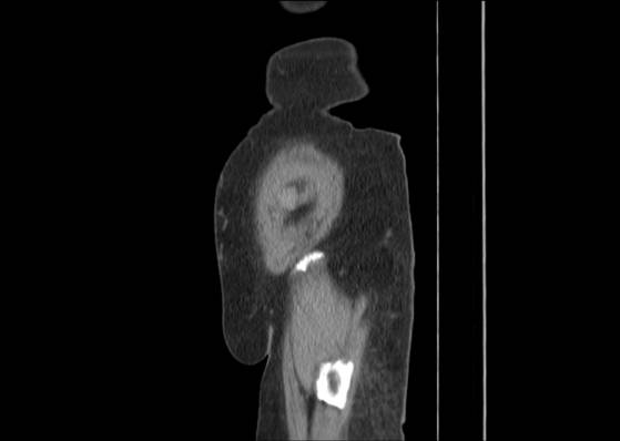 Bicameral celiacomesenteric aneurysm (Radiopaedia 55766-62327 B 55).jpg