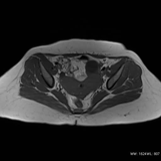 File:Bicornuate uterus (MRI) (Radiopaedia 49206-54297 Axial 11).jpg