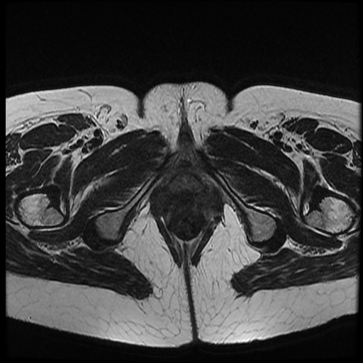 File:Bicornuate uterus (Radiopaedia 51676-57472 Axial T2 5).jpg