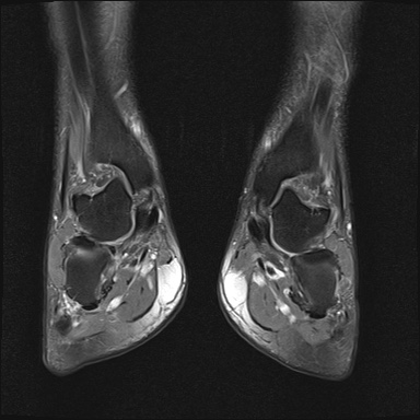 File:Bilateral Achilles tendon complete tear (Radiopaedia 81344-95051 Coronal PD fat sat 15).jpg