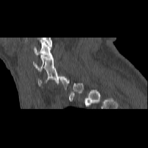 File:Bilateral C6-7 locked facet dislocation (Radiopaedia 28506-28748 Sagittal bone window 2).jpeg