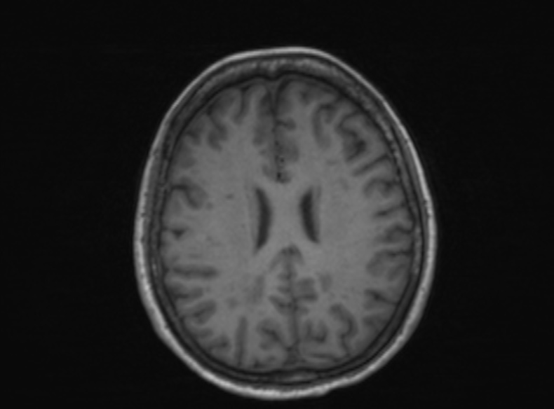 Bilateral PCA territory infarction - different ages (Radiopaedia 46200-51784 Axial T1 199).jpg