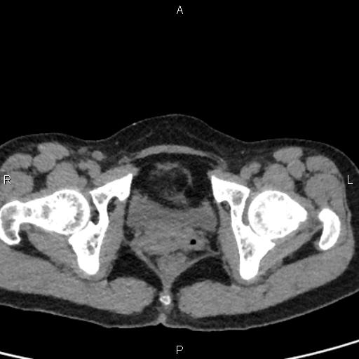 File:Bilateral adrenal gland hyperenhancement in pancreatitis (Radiopaedia 86642-102753 Axial non-contrast 107).jpg