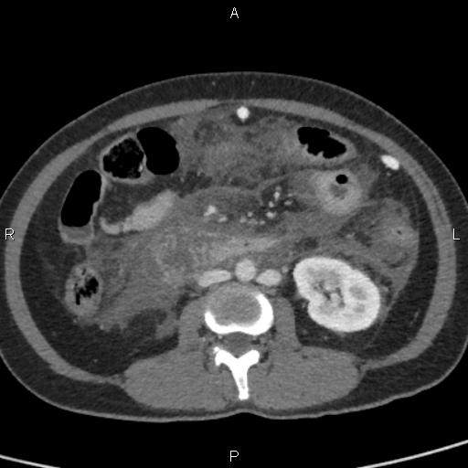Bilateral adrenal gland hyperenhancement in pancreatitis (Radiopaedia 86642-102753 E 58).jpg